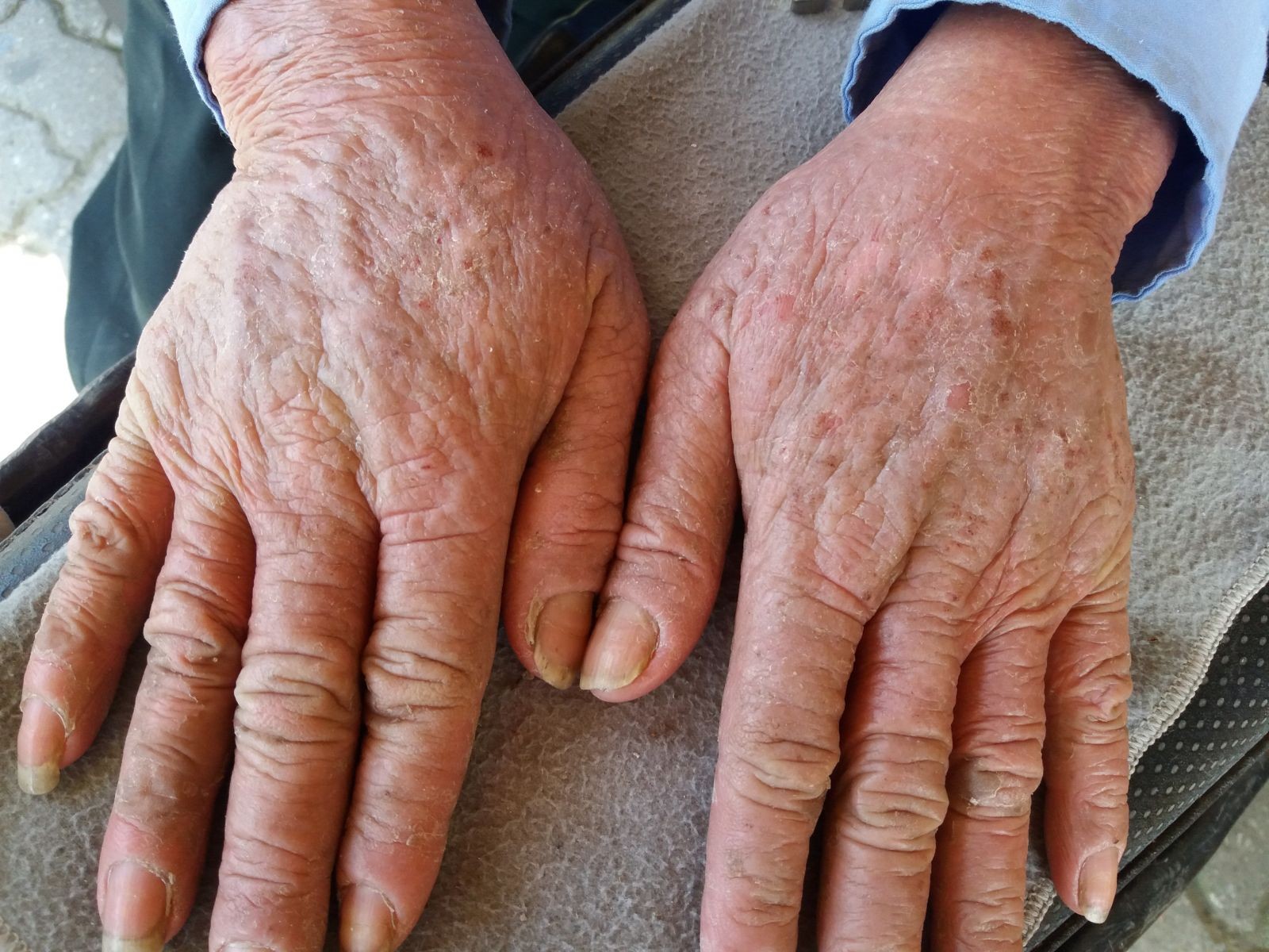 Tình trạng xi măng ăn tay diễn ra do hợp chất hexavalent chromium bên trong xi măng có tính ăn mòn, độc hại, tác động lên bề mặt da tay.