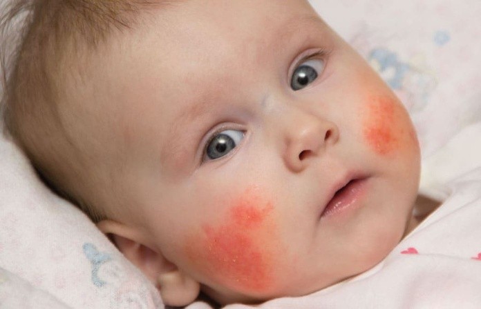 HSV căn bệnh quái ác